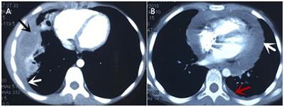 Case Report: Intermittent Chest Pain With Cough, Fever, and Pericardial Effusion Over the Course of 1 Year in an 11-Year-Old Girl